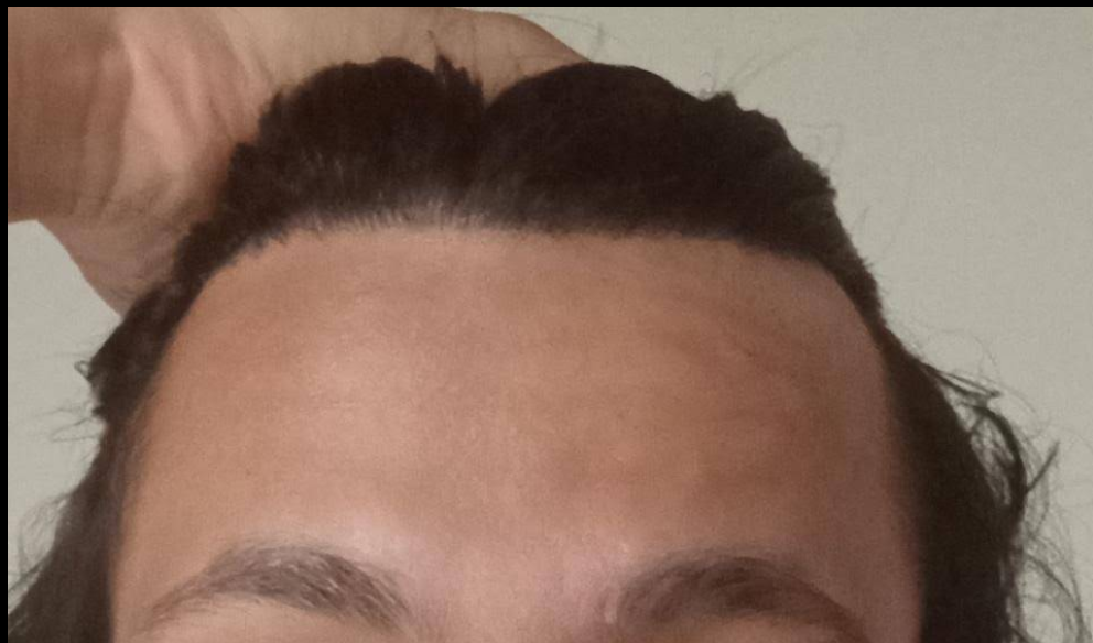 Lord Tetsu DHI hair transplant
